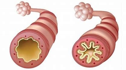 airway-hyperresponsiveness-in-asthma-is-related-to